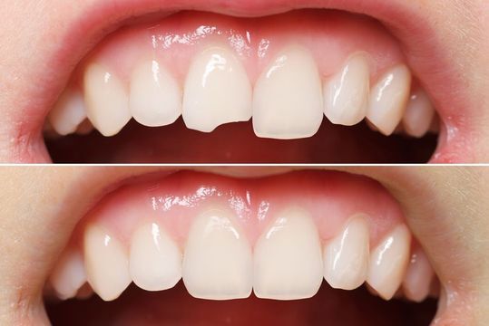 Before and after of a dental bonding patient