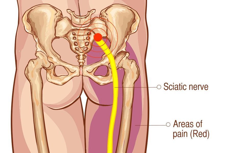 What Is The Treatment Of Sciatica Pain