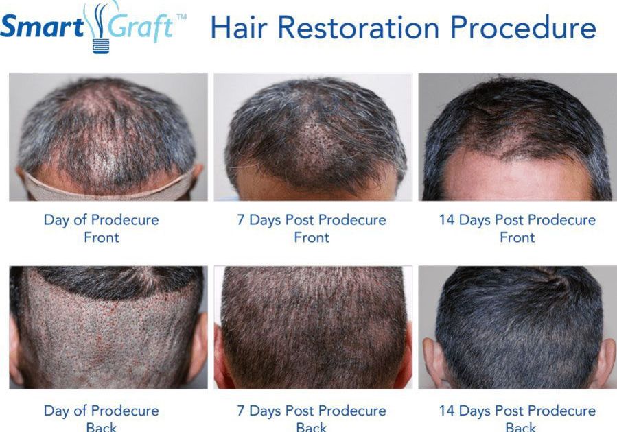Hair Restoration - San Antonio, TX - Dr. Constance Barone - SmartGraft