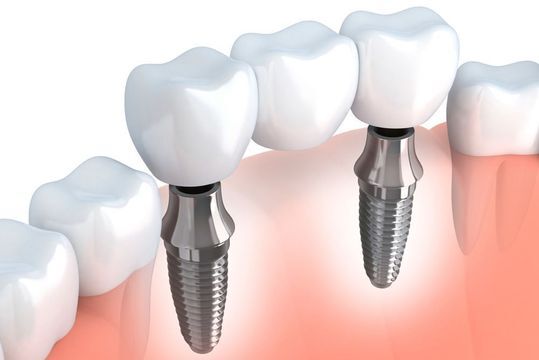 Image of dental implants and bridge