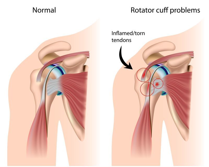 Rotator Cuff Pain: Treatment, Symptoms, Causes, and More
