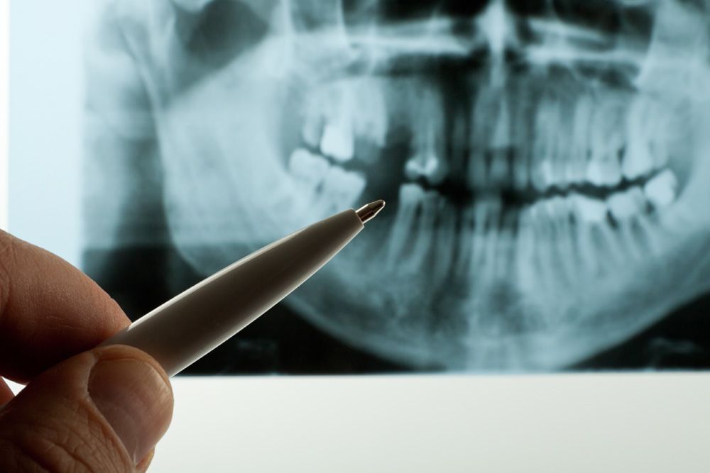 Image of dental x-ray