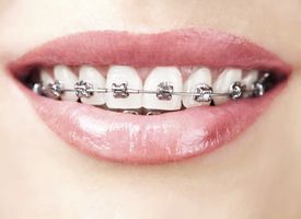 Close up of traditional braces