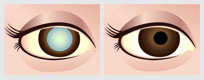 Graphic illustration of an eye with cataracts next to one without