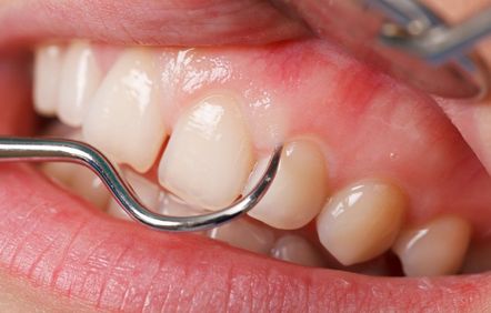 Close-up of a gum line and a dental tool