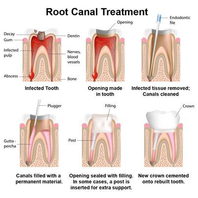 Illustration of root canal therapy. 