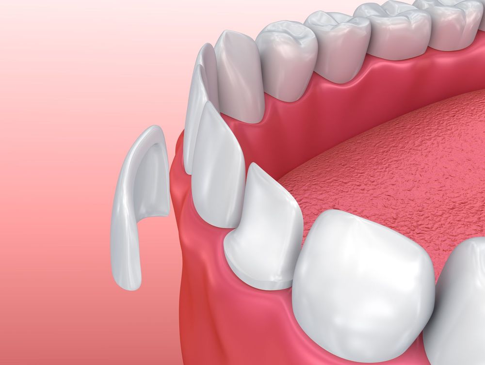 What Do Temporary Veneers Look Like? - WildeWood Aesthetic Dentistry