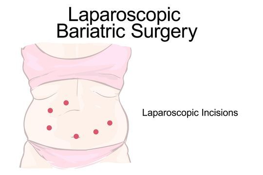 Bariatric Surgery Tijuana Mexico Lap Band® Gastric Sleeve And Bypass