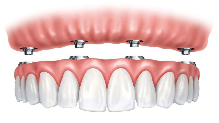 Illustration of an implant-supported denture