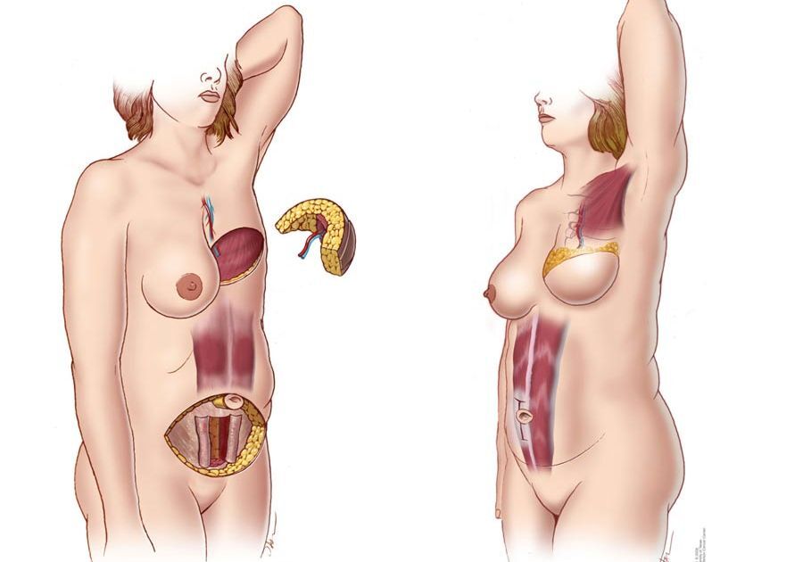 Breast mastectomy double reconstruction after After Mastectomy,