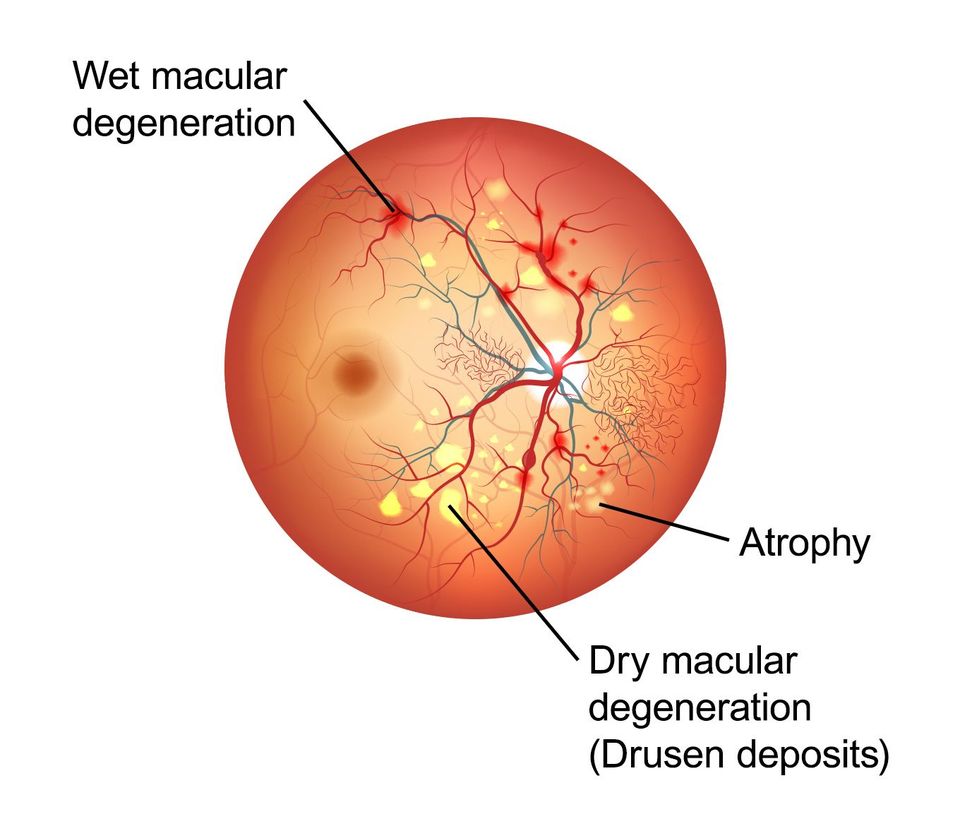 macular degeneration drusen