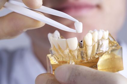 Image of dental implant restoration