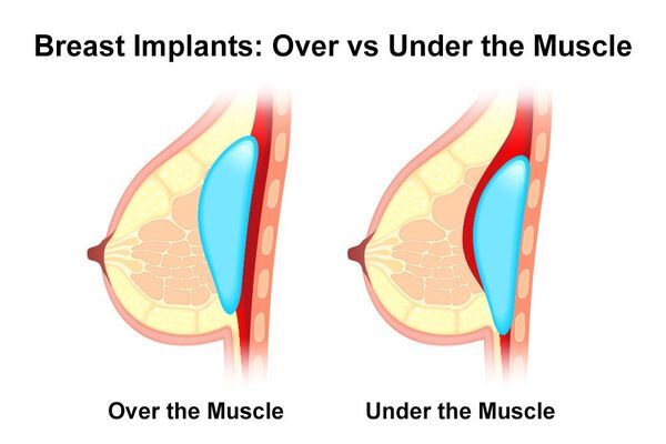 Image of breast implants over versus under the muscle
