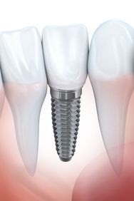 Titanium post of a dental implant. 