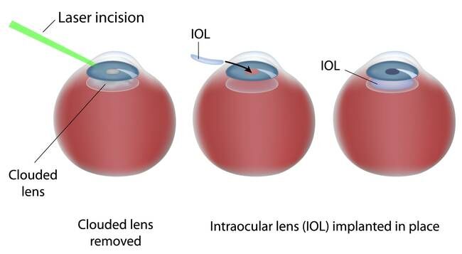 Graphic depicting stages of laser cataract surgery