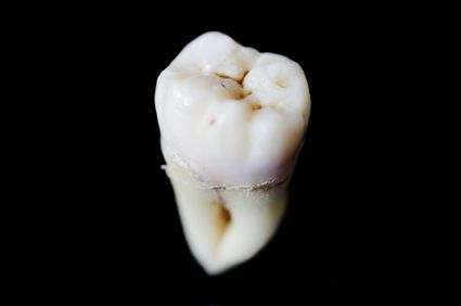 Image of extracted tooth