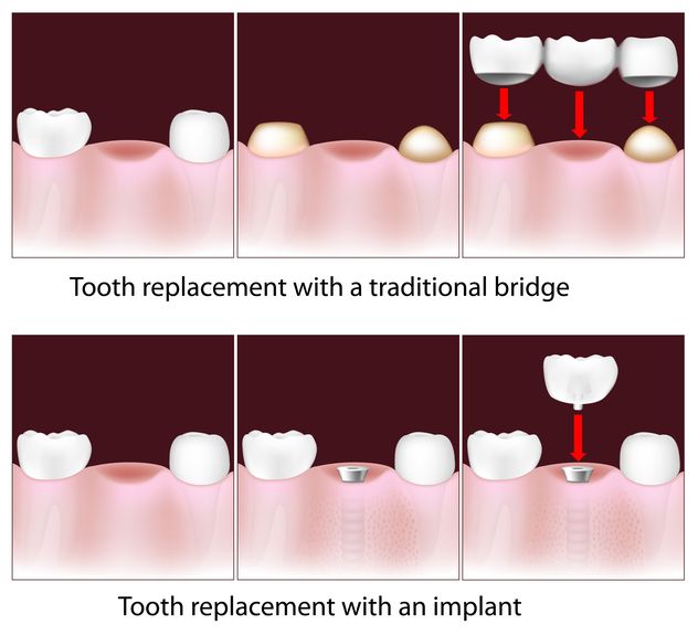 Illustration of a traditional bridge vs. dental implant