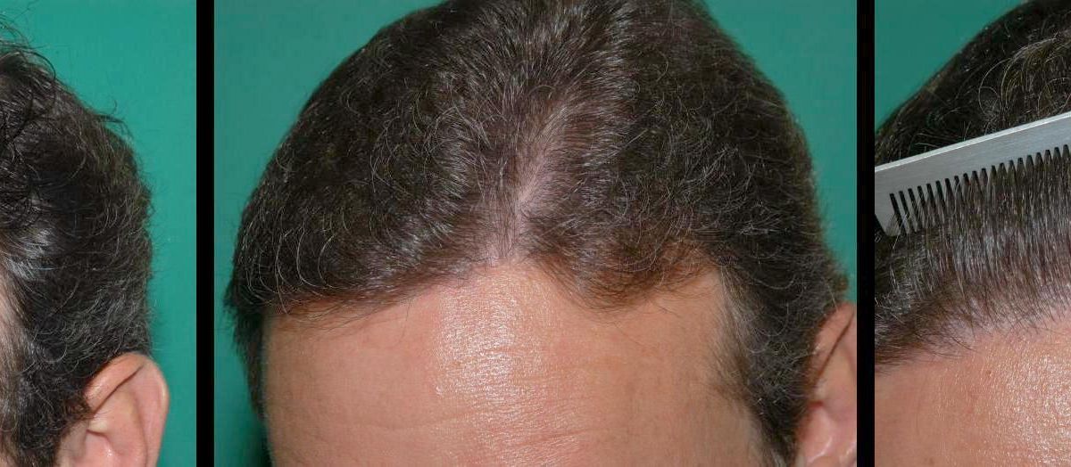 Repair of Older Hair Restoration Techniques - Chicago Hair Institute